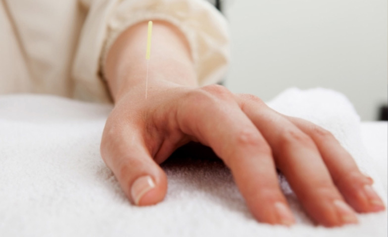 a hand with acupuncture needle